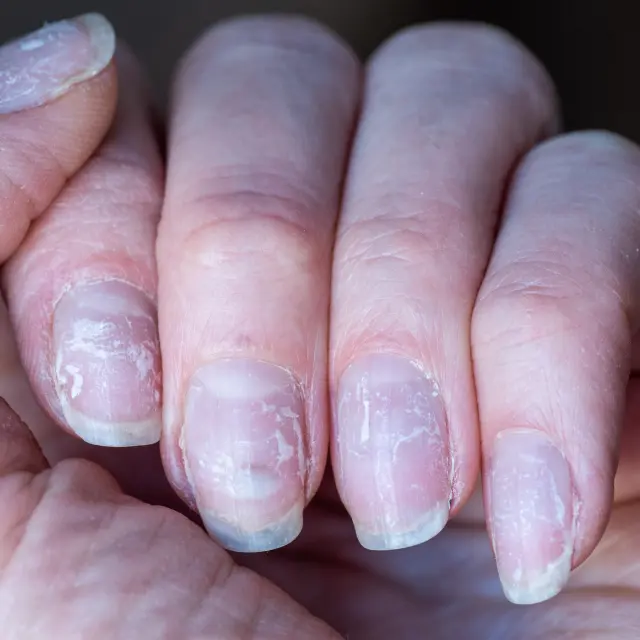 Remedio casero para fortalecer las uñas por usar acrílico
