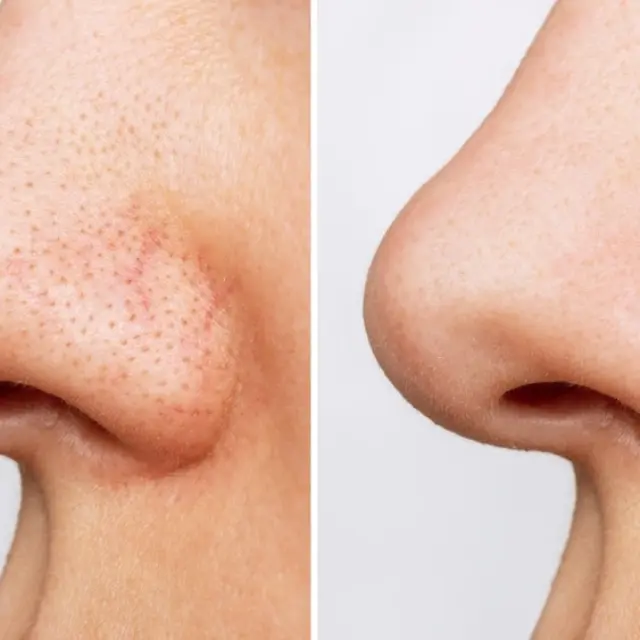 Cuidado de la piel: cómo disimular los poros abiertos